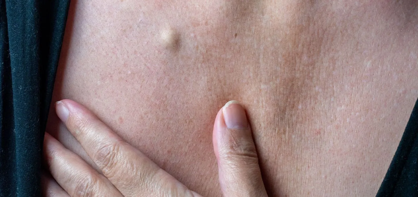 What Are Cysts? Understanding the Different Types