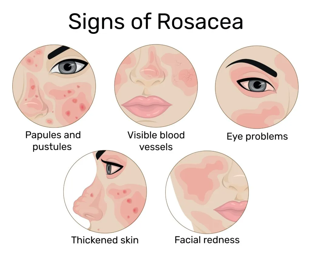 Common Symptoms of Rosacea